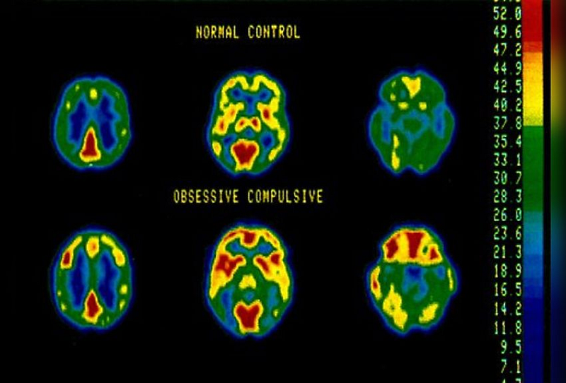 Brain Imaging of OCD Patients