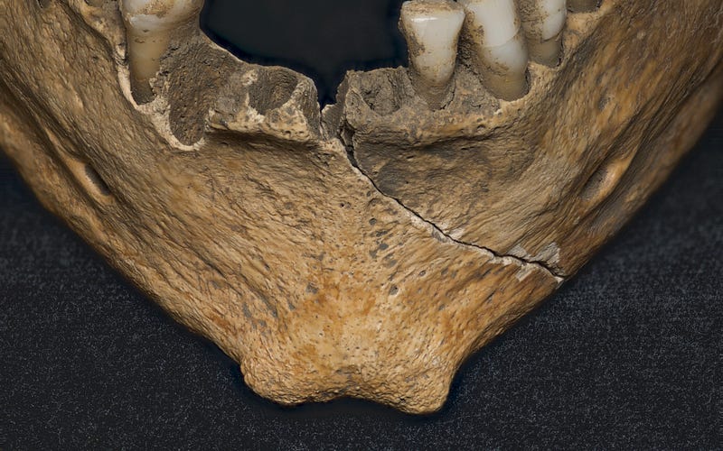 Mandible of archaeological remains revealing a cleft chin