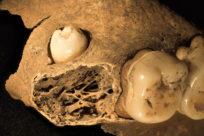 Impacted wisdom tooth captured through focus stacking